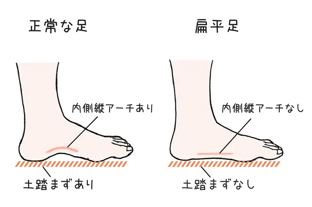 足のむくみの原因は?解消が期待できる生活習慣やマッサージを美容ライターが解説 正常な土踏まずと扁平足の比較イラスト